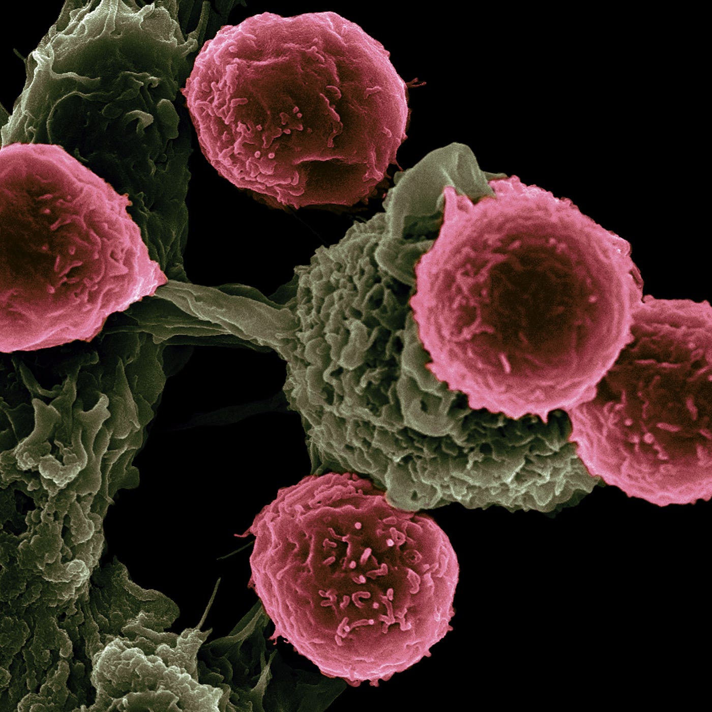 Cancer cell (yellow-green) being attacked by five pink-coloered immune system cells. Black background.