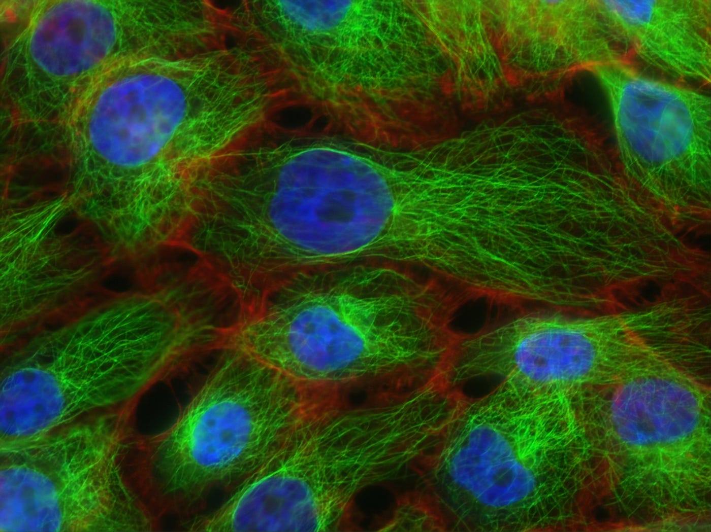 Photomicrograph of breast cancer cells. The cell body is blue with surrounding tissue fluorescent green.