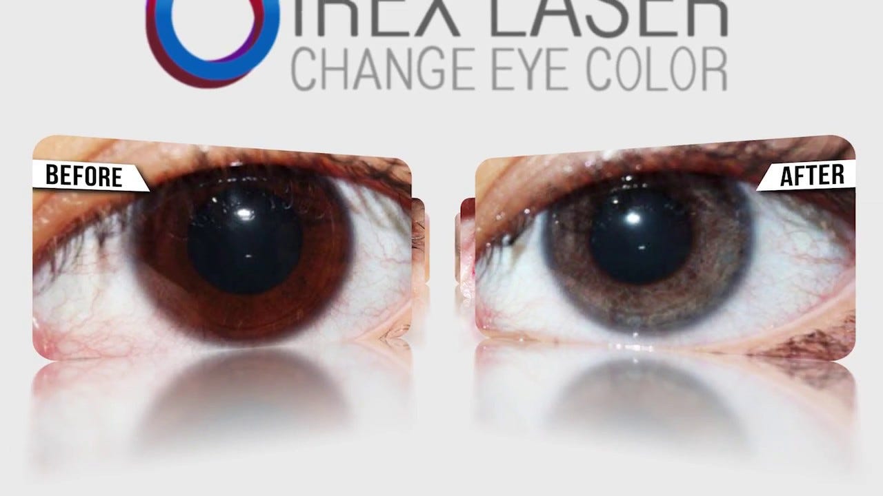 Change Eye Color Permanently With Laser Procedure Bheldi Blogs