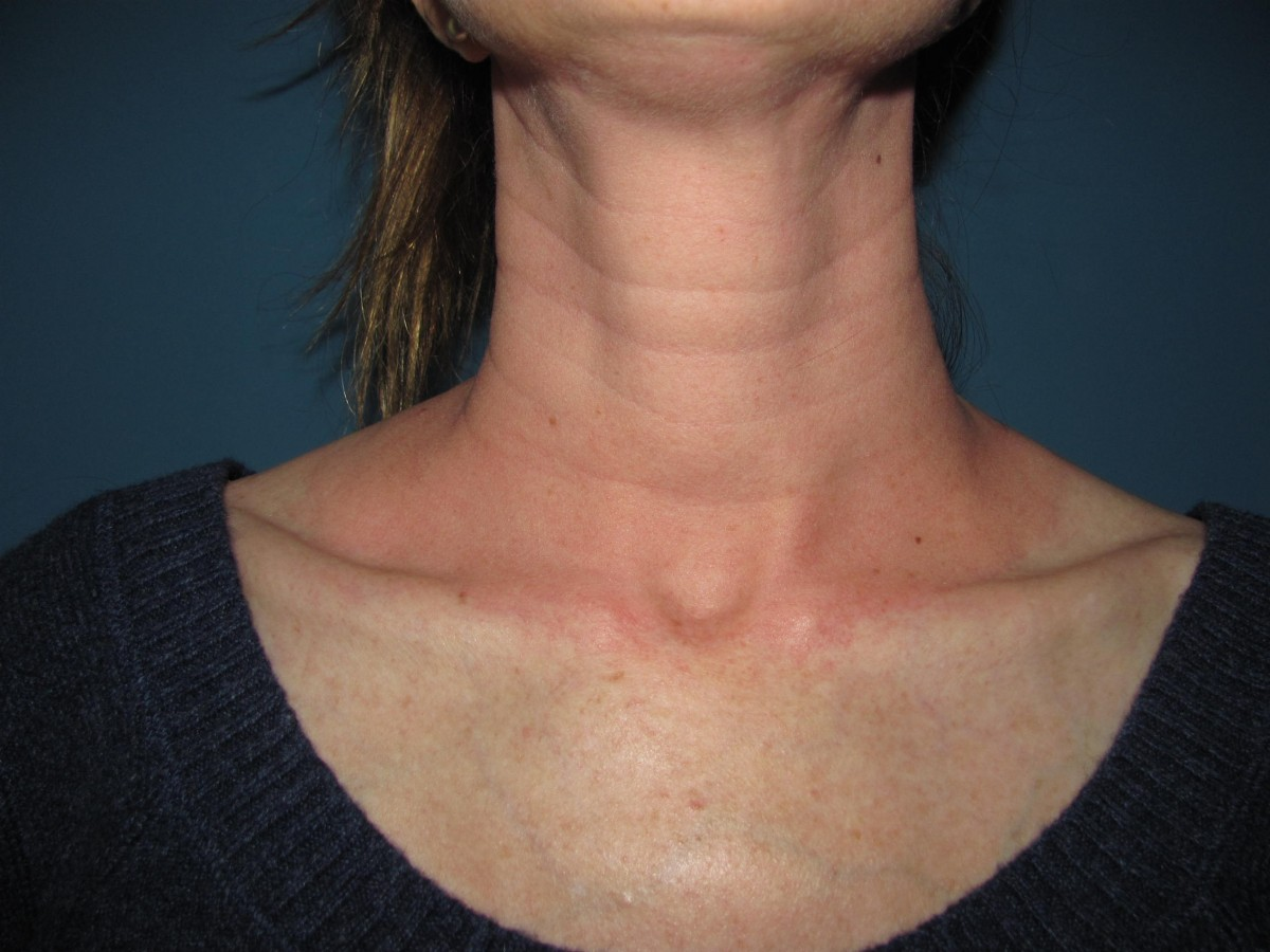 What is Tech Neck And What You Can Do About It by Ashley Worsham Medium