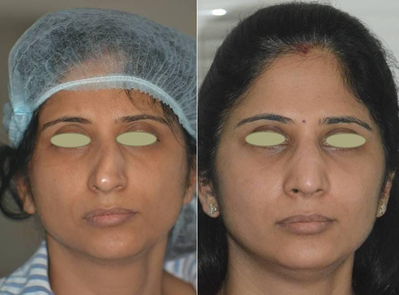 The Single Most Common Cause Of A Failed Rhinoplasty By Dr Brajendra Baser Medium