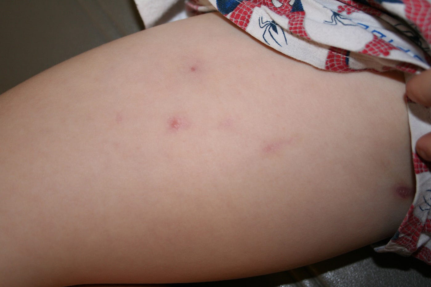 Try Easy Home Remedies for Boils on Inner Thigh | by healthy & stylish |  Healthy & Stylish | Medium