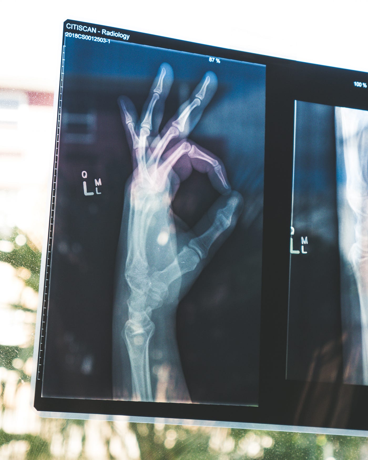 Plain films (single view X-ray) of a left hand making an “okay” sign.