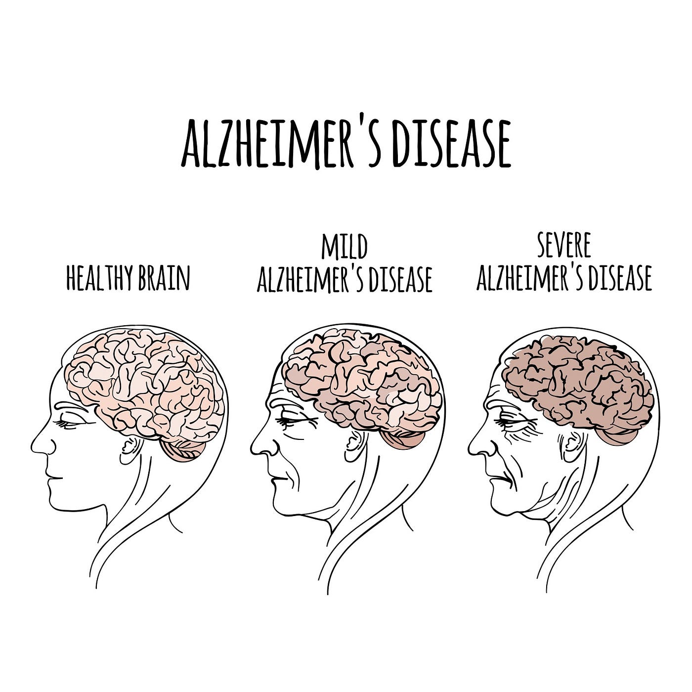 Alzheimer’s Disease: The 7 Stages of the Disease | by Christopher Noel ...