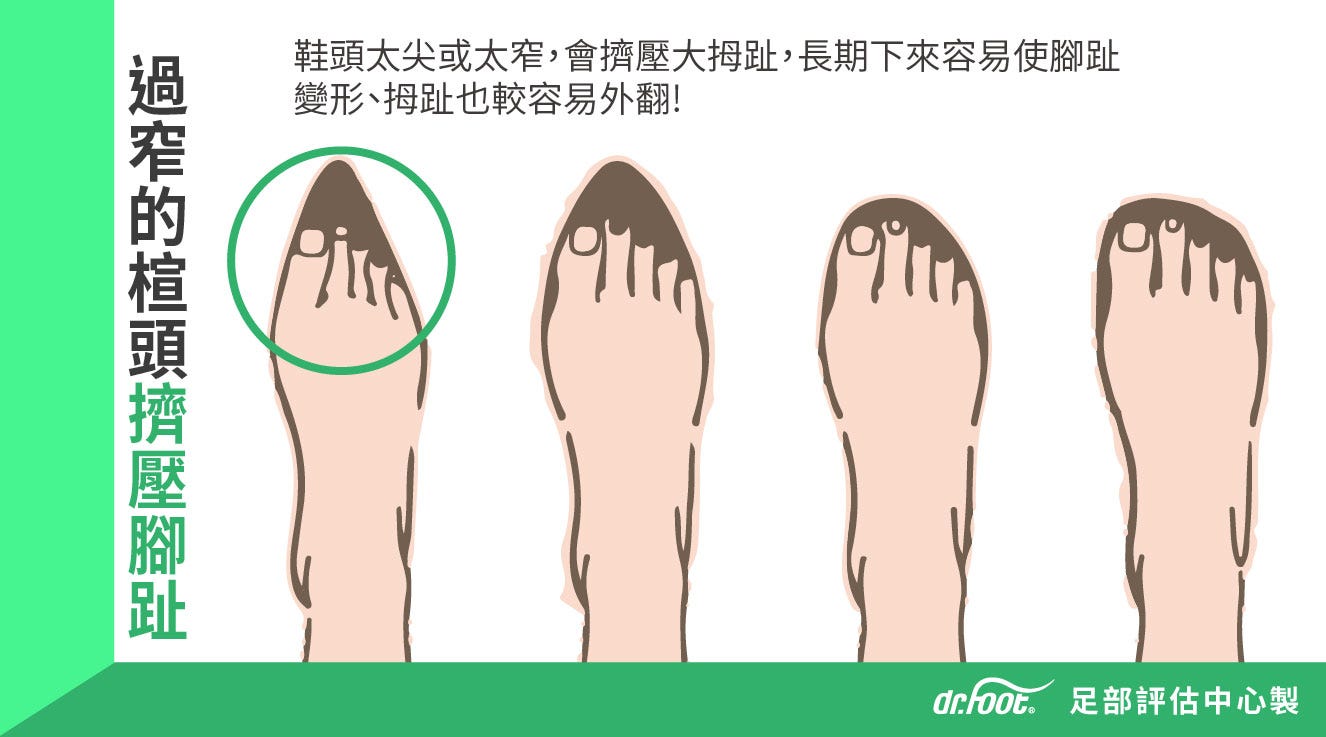 你知道每3 4個成年人就有1個人受拇趾外翻困擾嗎 曾經有朋友聽到我有拇趾外翻時露出 感覺很痛 的表情 聊了五分鐘後發現他以為是指甲 By Emily 愛米粒