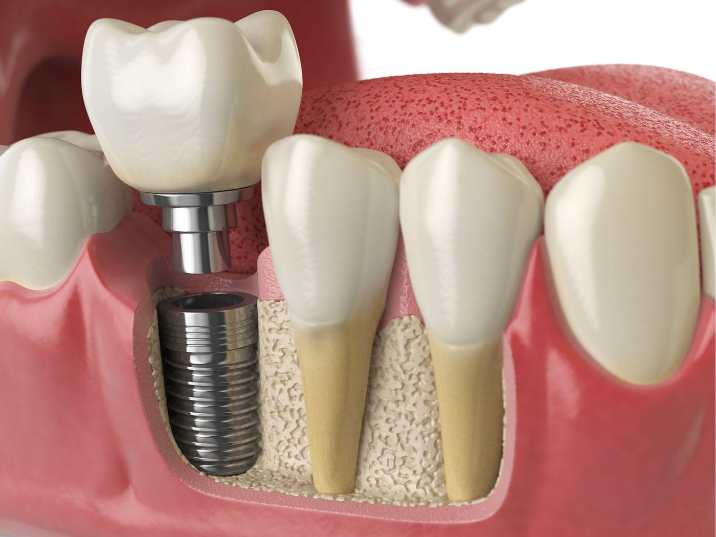 Dental Implants Los Angeles