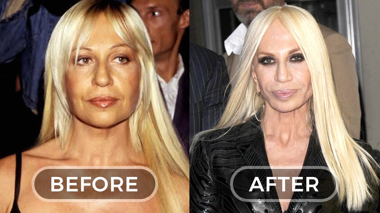 Celebrities Before and After Plastic Surgery, Which Changed Out of All  Recognition | by Marta o_d | Medium