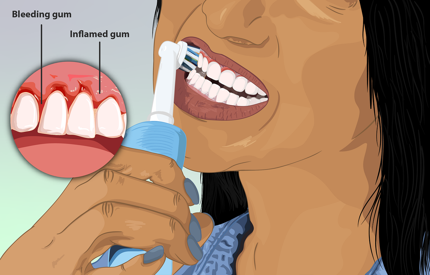 WHY DO MY GUMS BLEED?. 10 Causes of Bleeding Gums by Dr. Sheema Azhar
