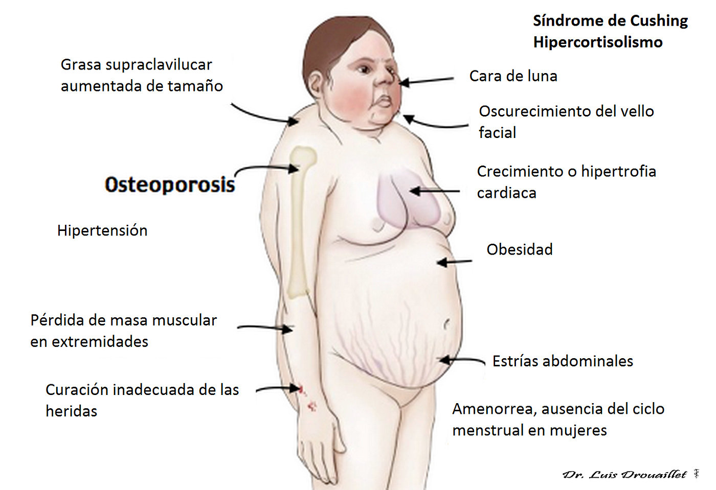 Obesidad tipo 1 síntomas