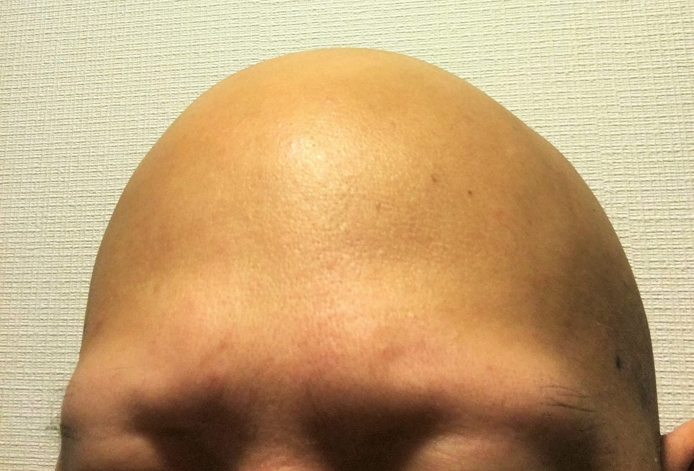 脱毛症や無毛症について知ってほしいこと これは私自身のこととして というよりも 世の中にいる脱毛症や無毛症に悩む人のため By Yusuke Kuroda 黒田 悠介 文系フリーランスって 食べていけるの Medium