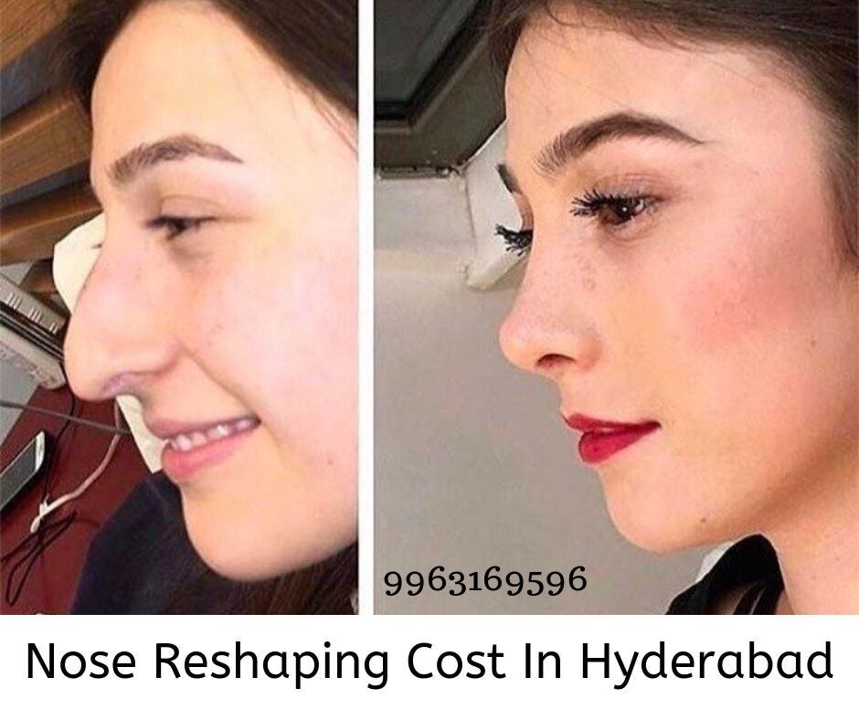 Top Reasons For Choosing A Nose Surgery Intervention By Naresh Medium