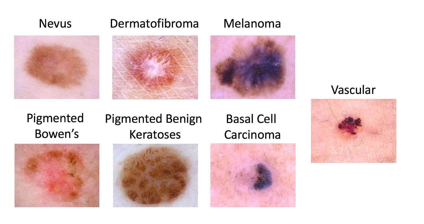 Machine Learning for the ISIC Cancer Classification Challenge #2: Deep ...