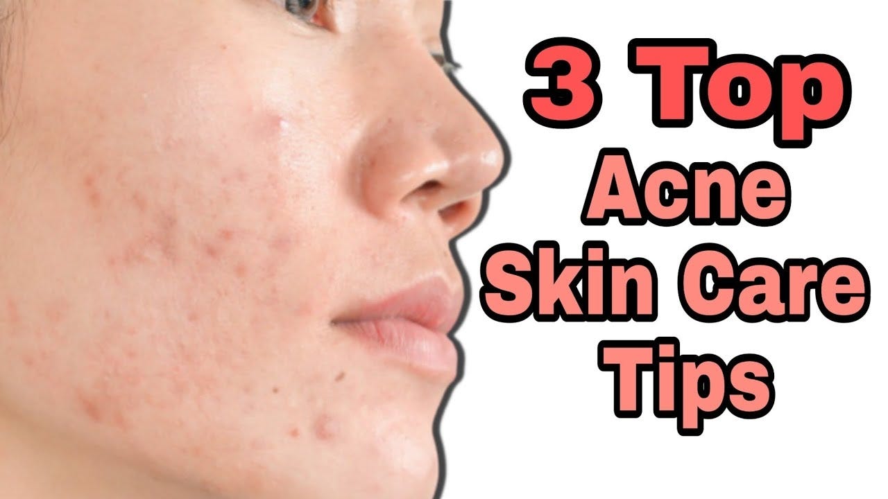 3 Top Acne Skin Care Tips For A Healthier Skin by Frank Henry Aug
