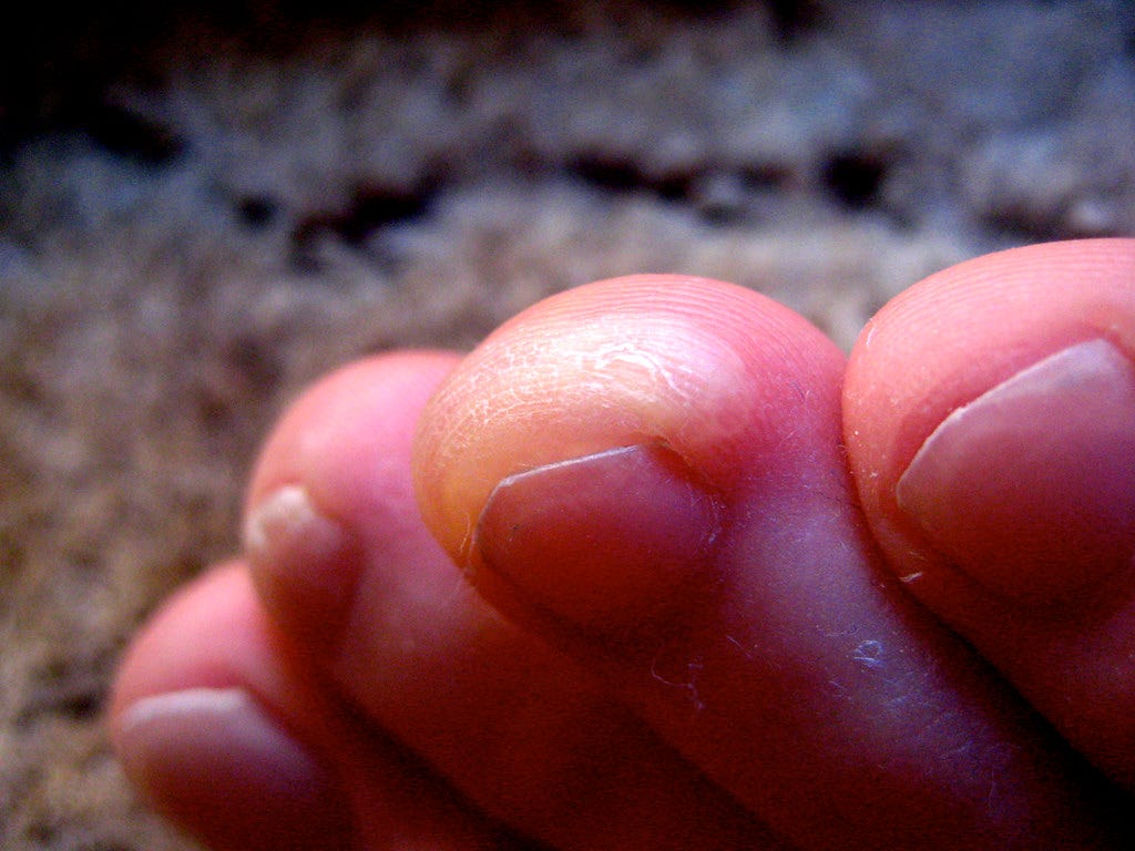 blisters from hiking
