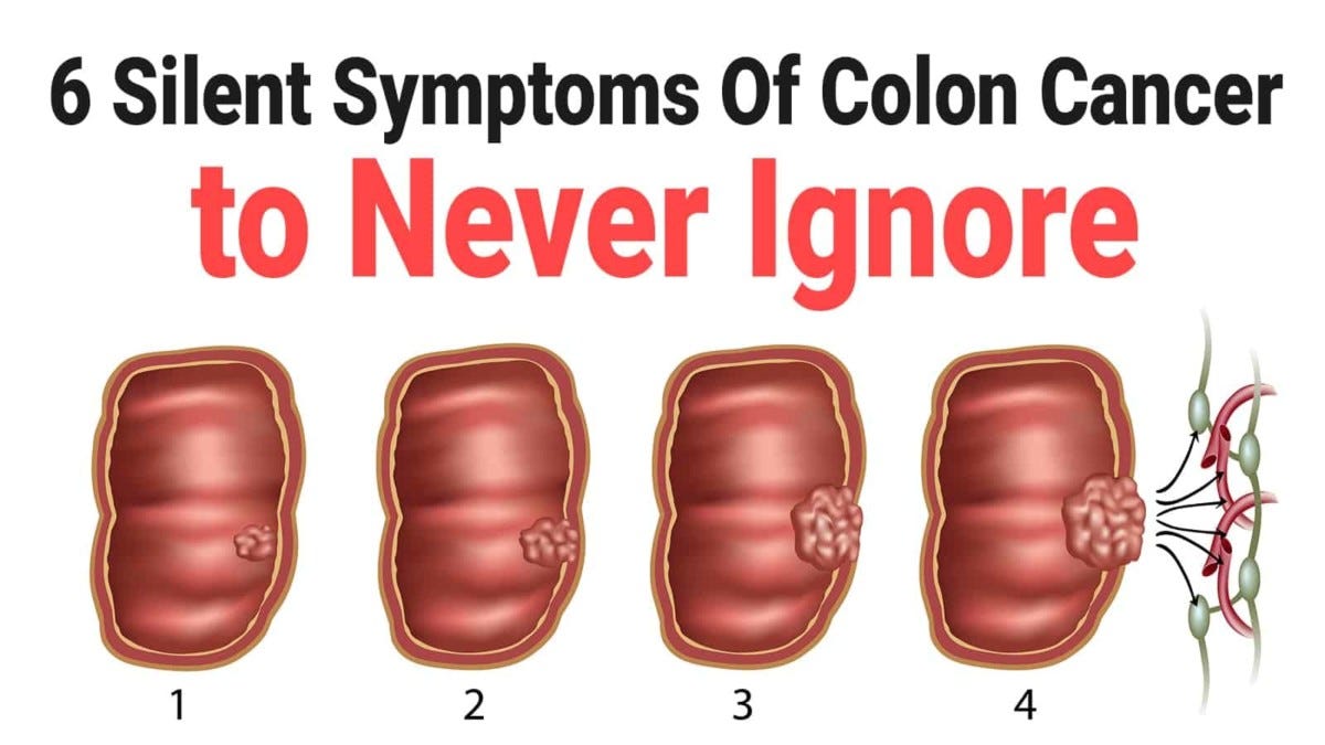 Dr. Akram Ismail — Colon Cancer