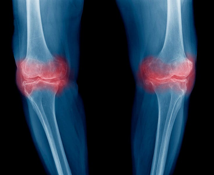 mrvica u bolovima u koljenu je jaka bol u zglobu koljena i donjem dijelu leđa