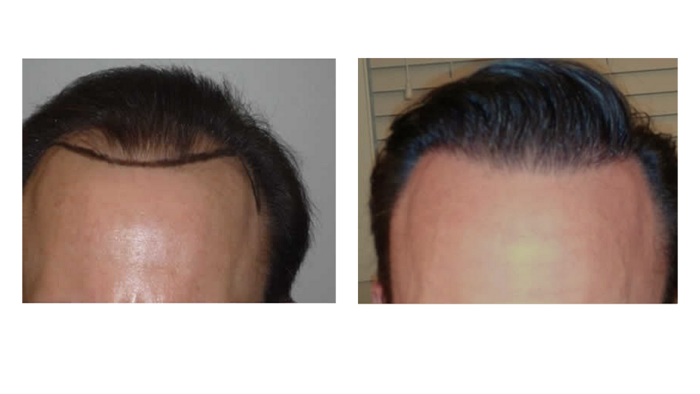 the-top-five-benefits-of-a-hair-transplant-by-jason-conley-medium