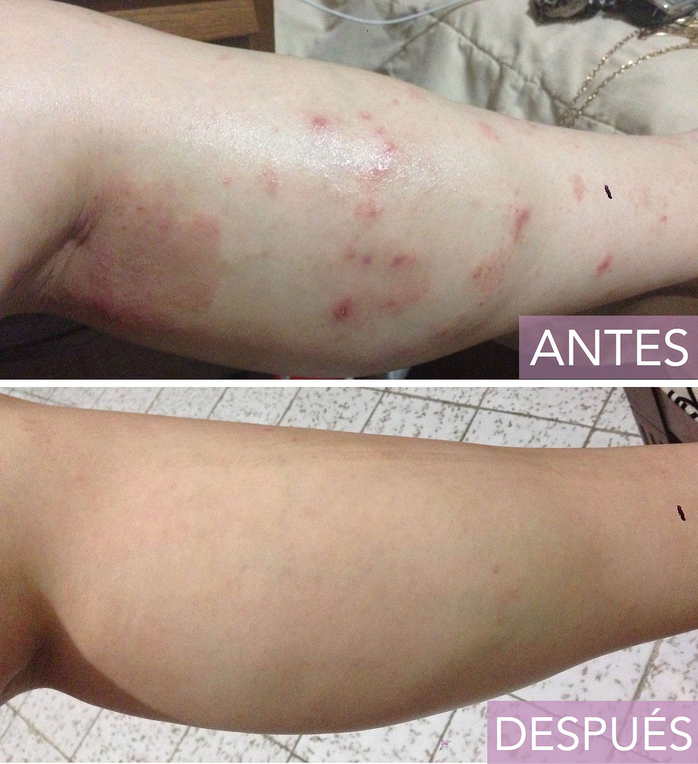 Dermatitis Atópica: ¿Un problema sin solución? | by Estefanía Mascareñas |  Belleza y Salud | Medium