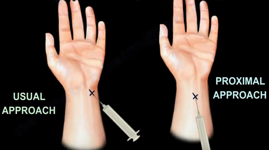 Carpal Tunnel Injection. As the median nerve travels through the… by