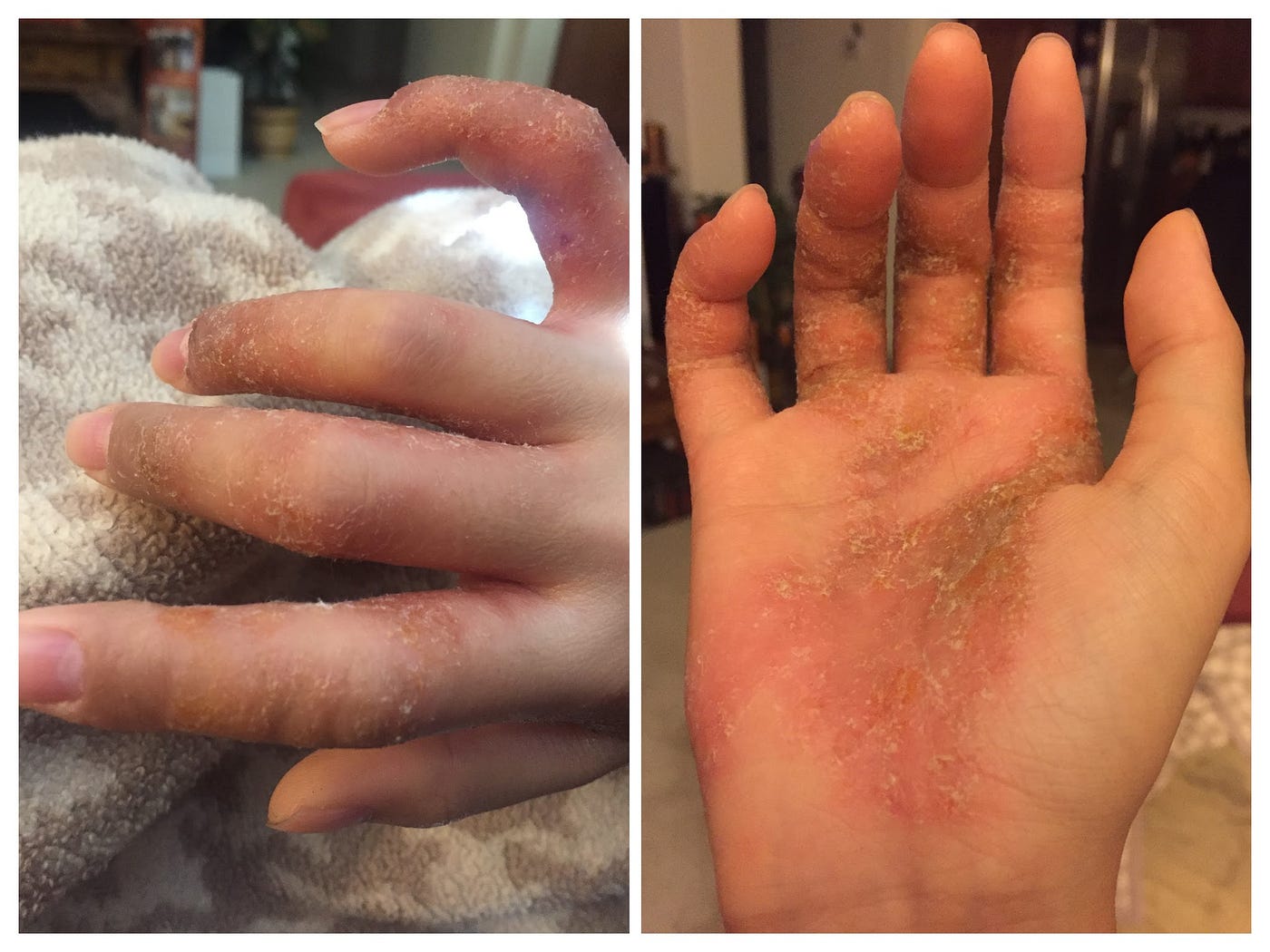 eczema autoimmune diet