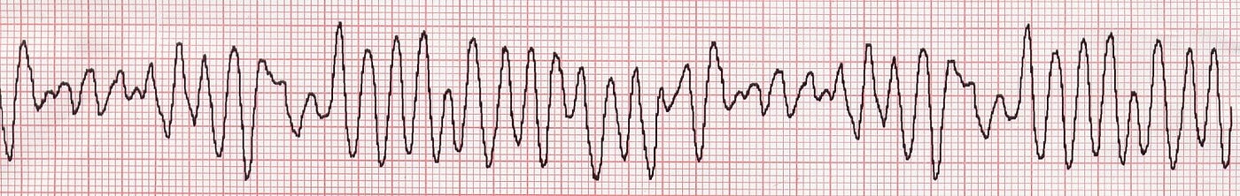 一 心室纖維顫動 Vf 及無脈性心室頻脈 Pvt 的特性 1 心跳停止 80 90 是由於心室纖維顫動 Ventricular By 臨床筆記 Medium
