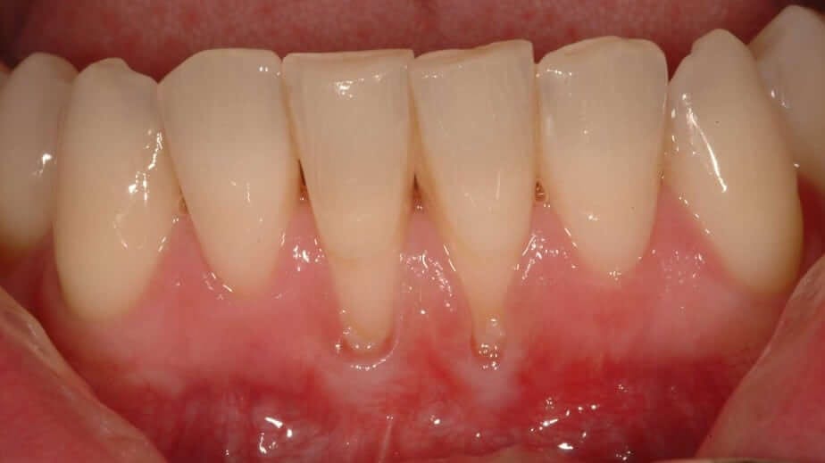 Best Way To Reverse Gums