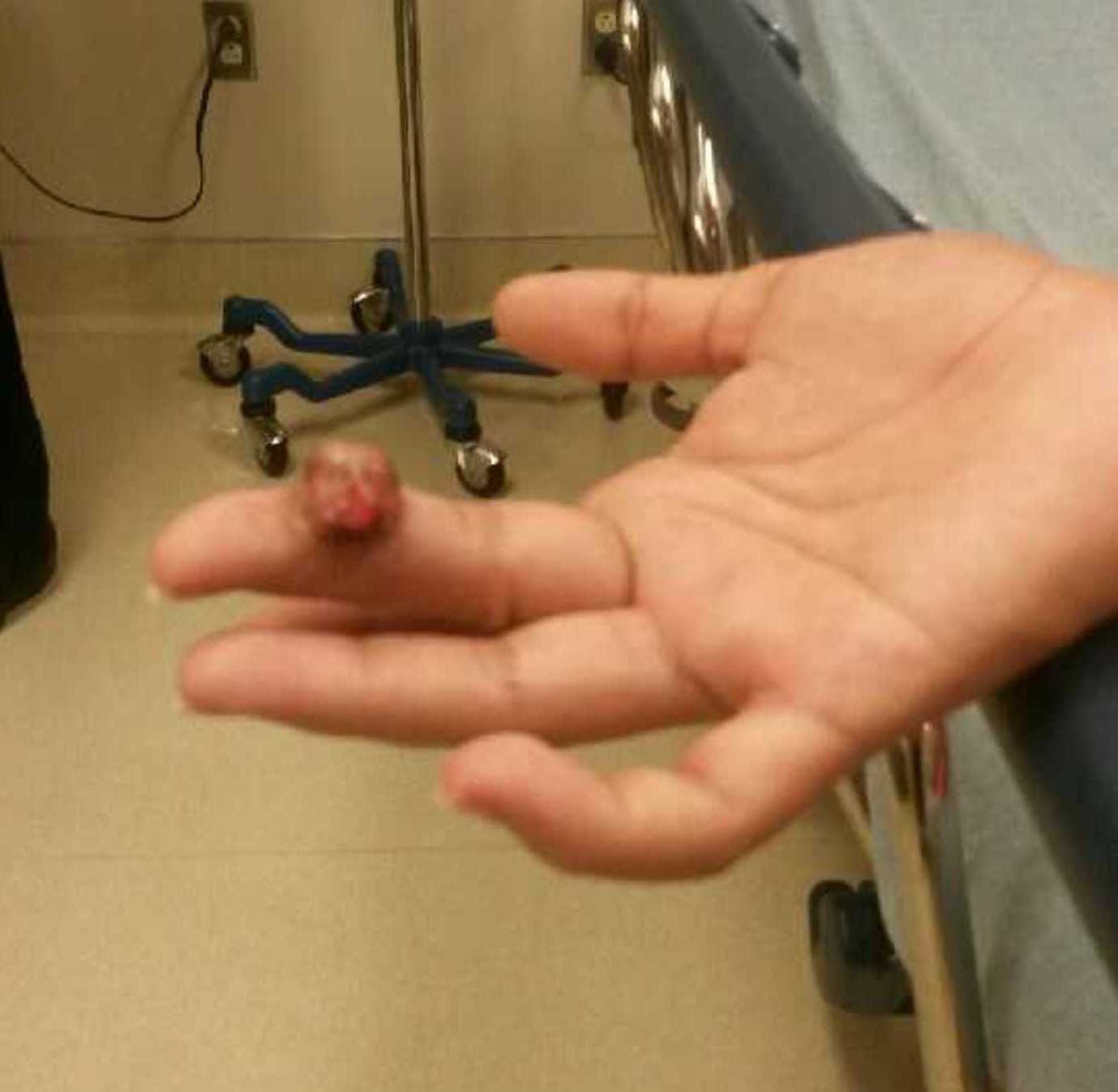 How Did A Cactus Affect This Pregnant Patient By Figure 1 Figure 1 Medium