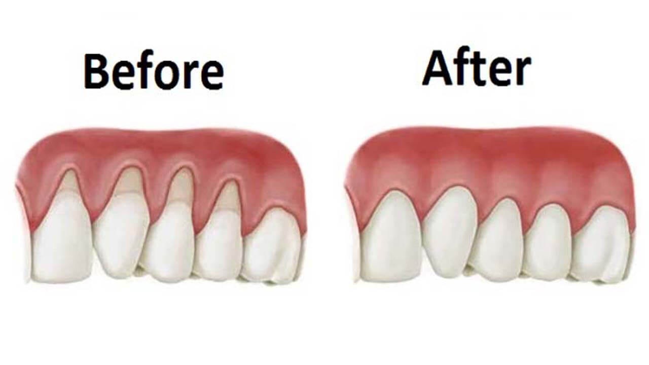 How To Reverse Receding Gums Reddit?