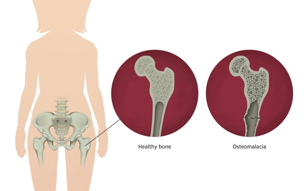 osteomalacia bone