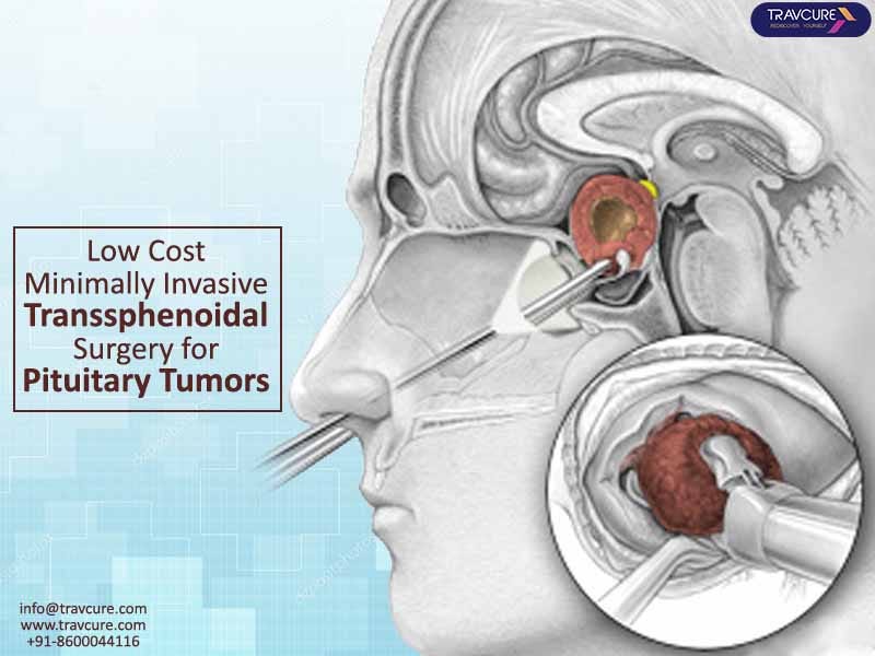 Low Cost Minimally Invasive Transsphenoidal Surgery for