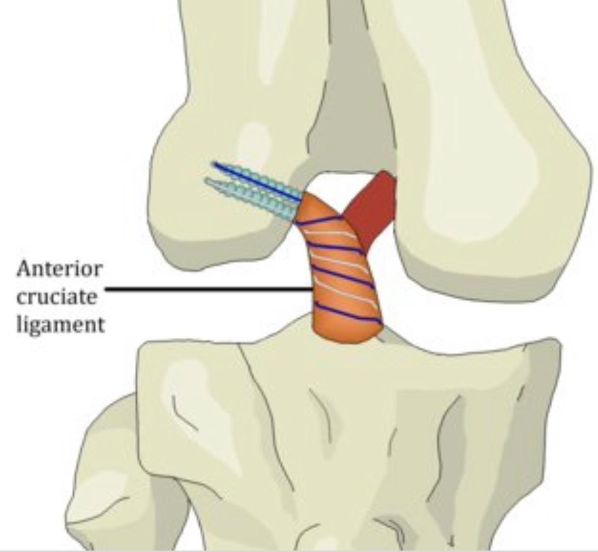 Save The Acl Primary Acl Repair Back To The Future By Dr Umerbutt Medium