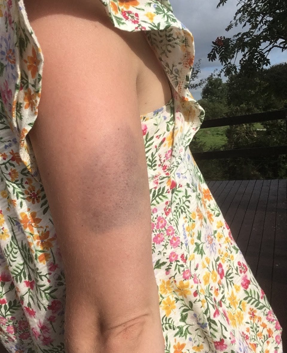An arm with a large bruise on it.