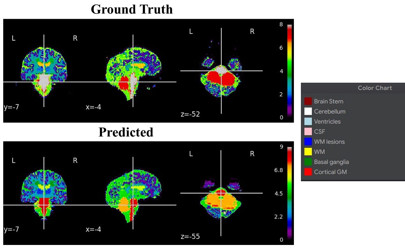 Brain MRI Segmentation using Deep Learning | by Abhijeet Khangarot ...