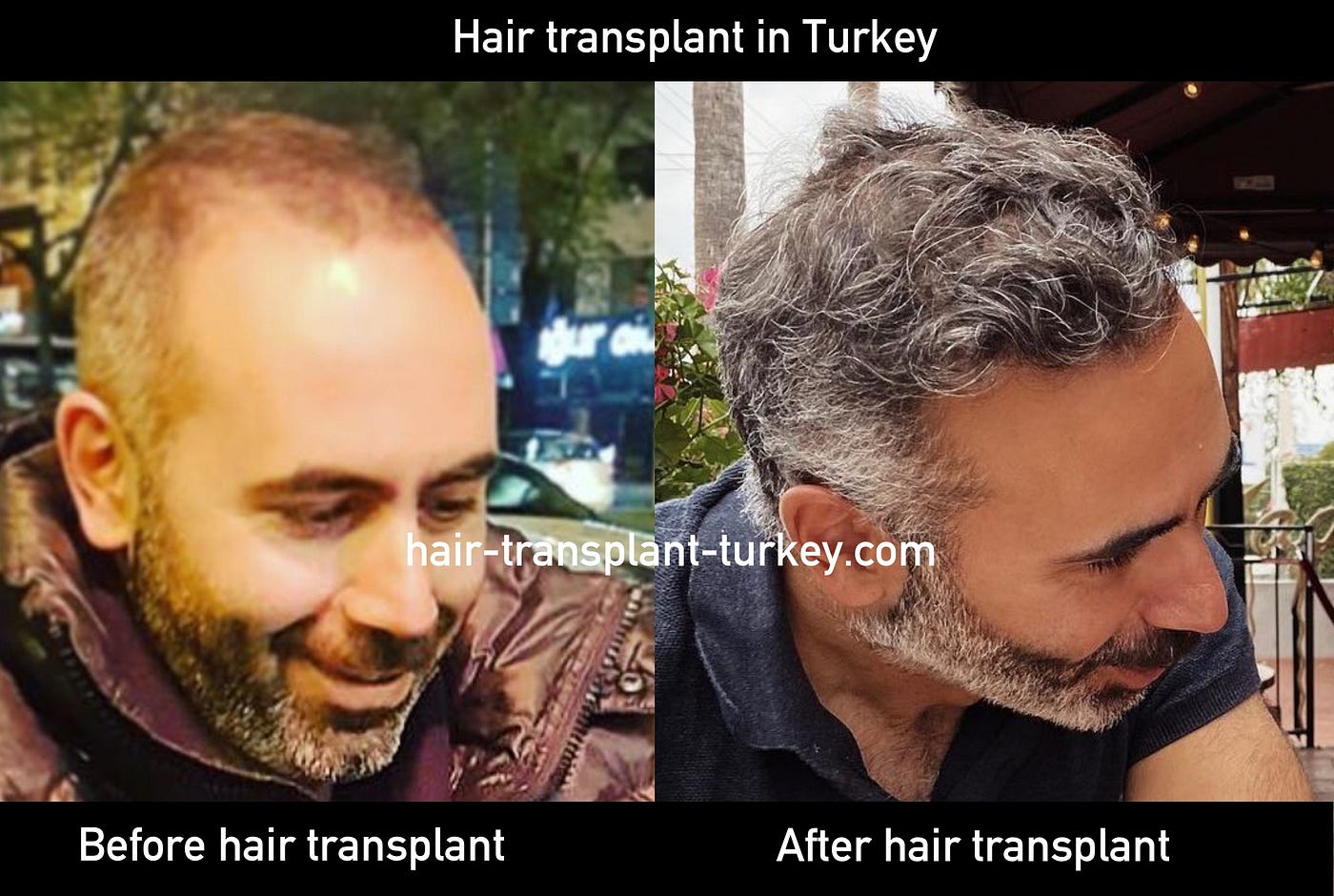 Hair transplant in Turkey | Ekim Nazım Kaya