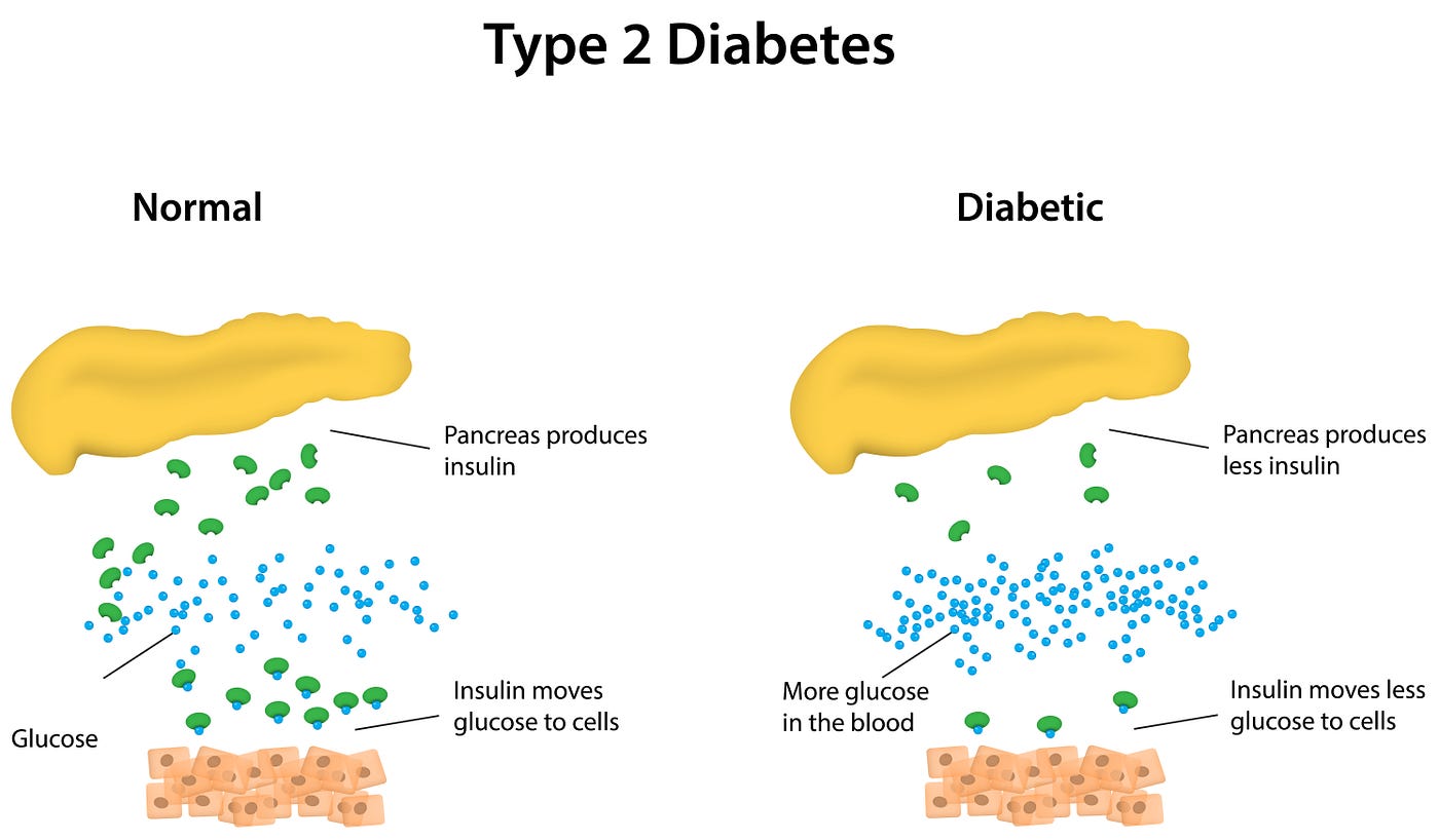 diabetes ncbi 2021)