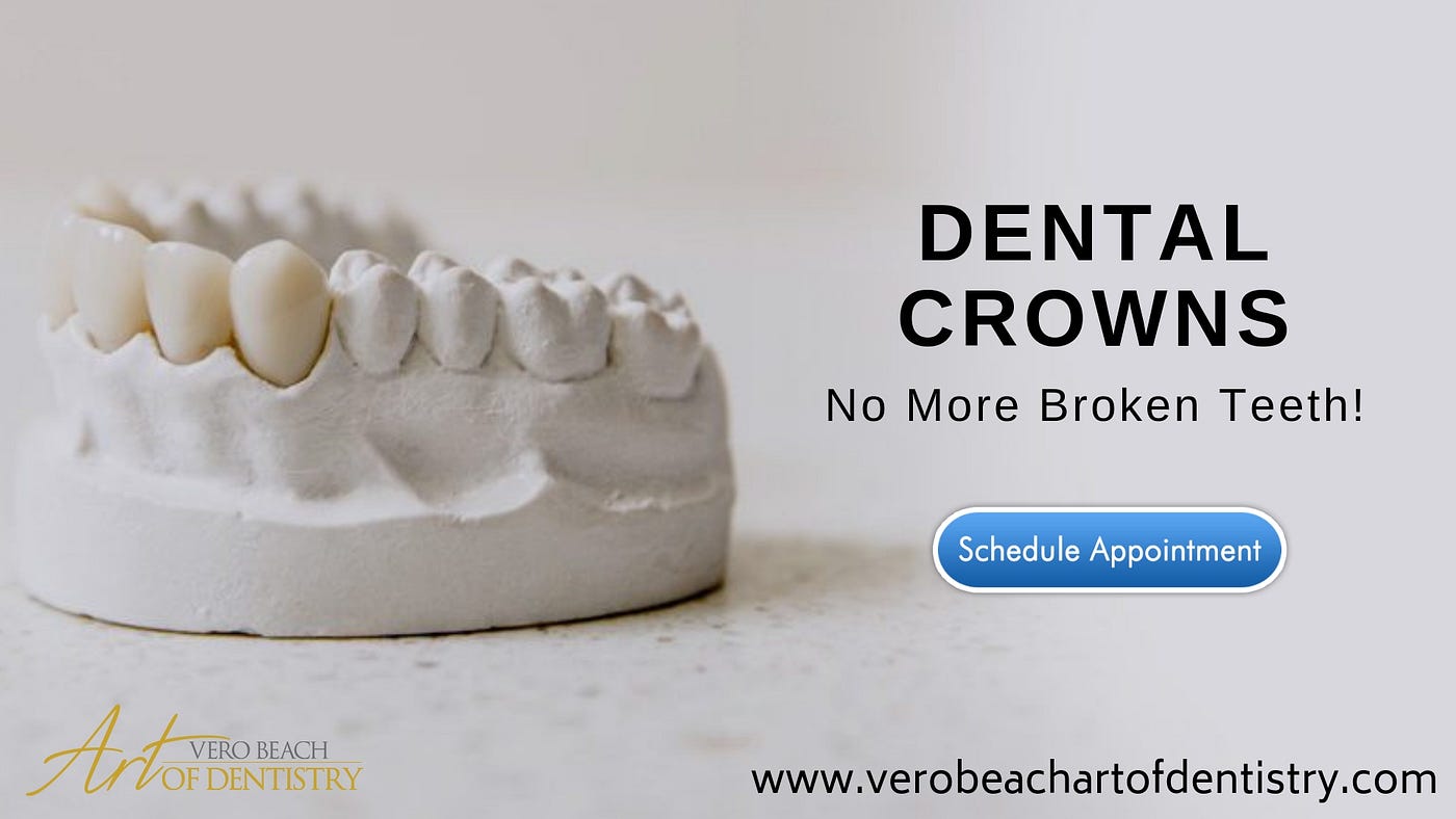 Natural Looking Bridge Tooth Replacement by Vero Beach Art of Natural Looking Bridge Tooth Replacement by Vero Beach Art of