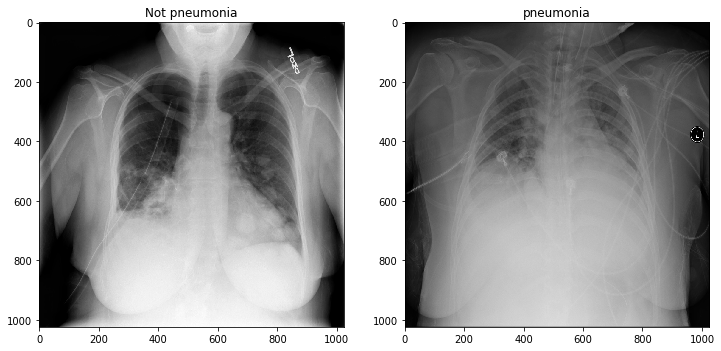 chest x ray pneumonia