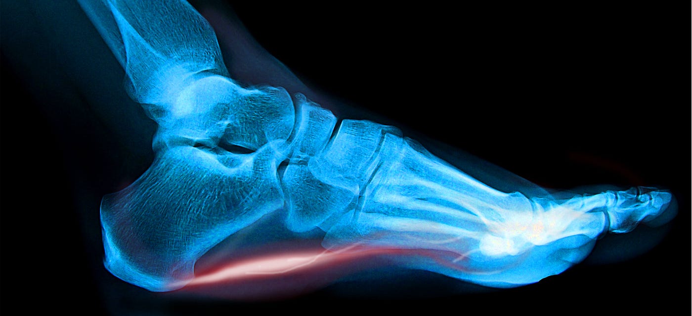 Giving Hope to Those With Plantar Fasciitis: How the Right Tools Can ...