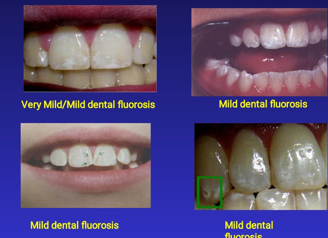What Does Fluoride Do In Toothpaste Is It Safe By Raveena Anjalee 