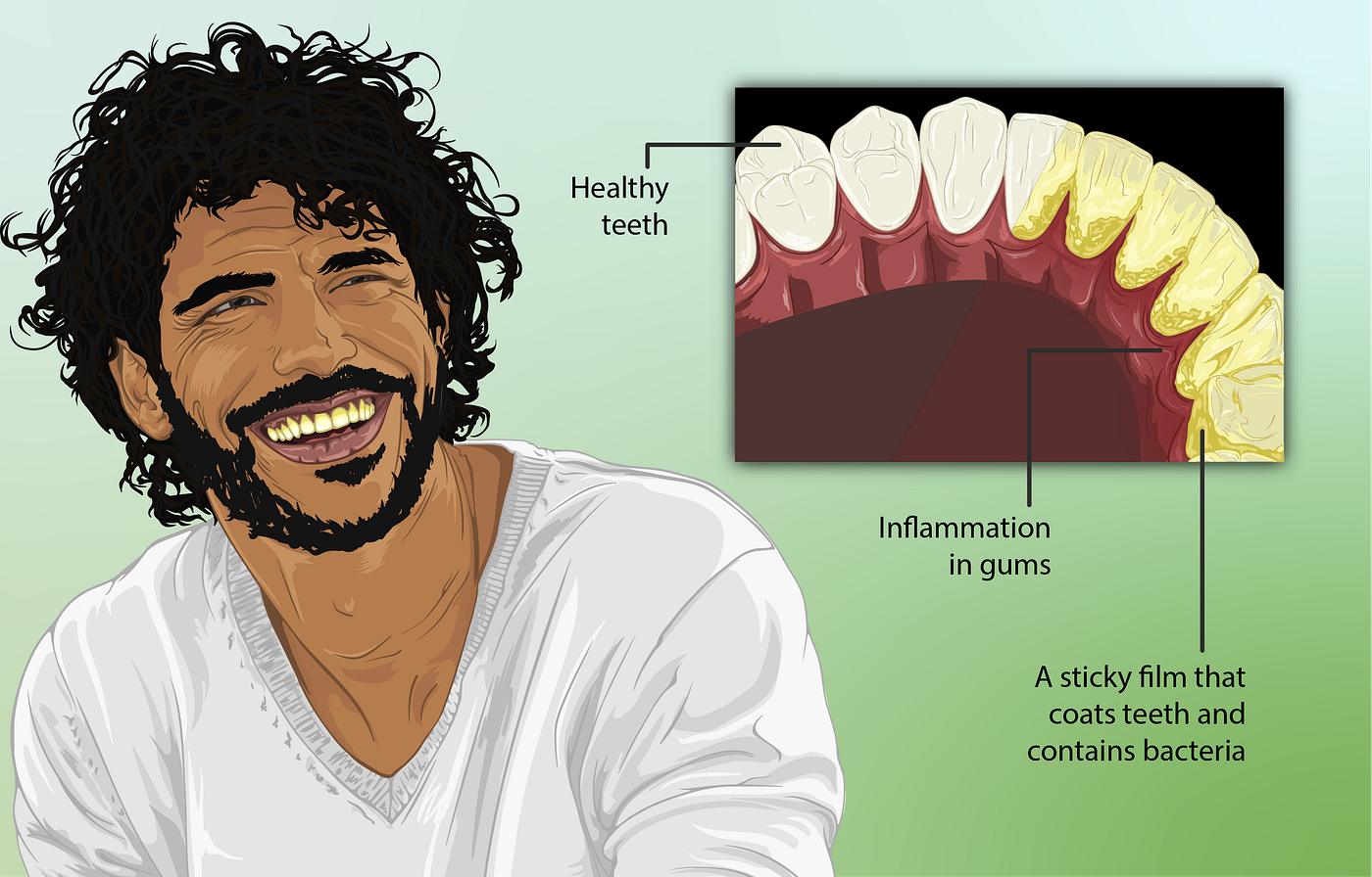 WHY DO MY GUMS BLEED?. 10 Causes of Bleeding Gums by Dr. Sheema Azhar