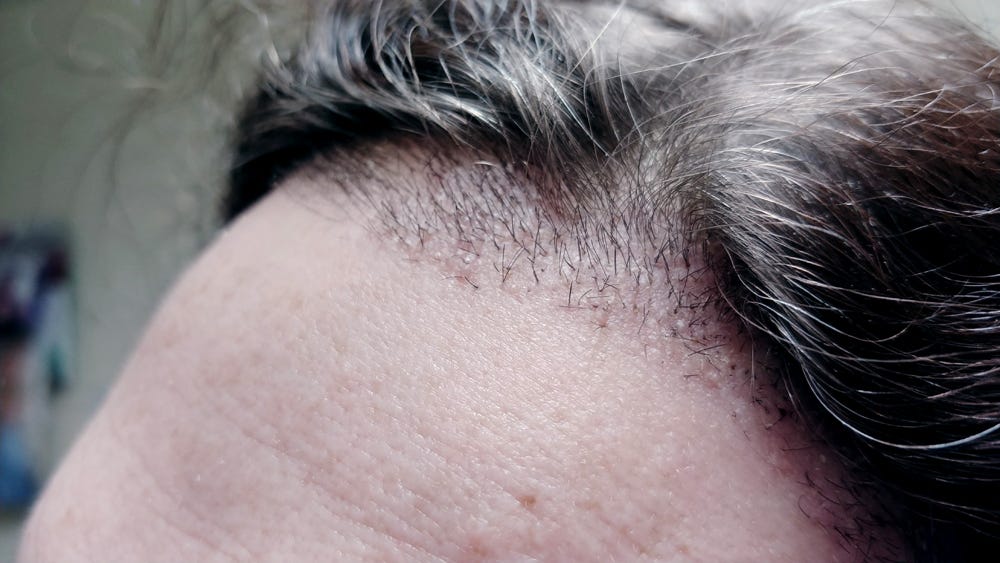 I Got A Hair Transplant — Here's What It Was Like (With 
