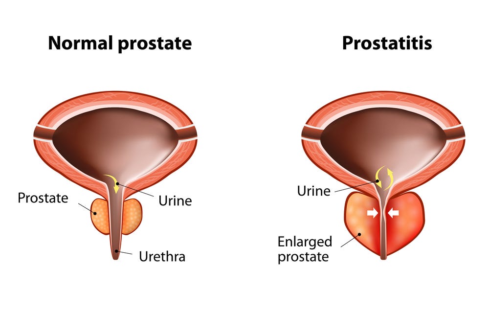 testosterone and prostatitis