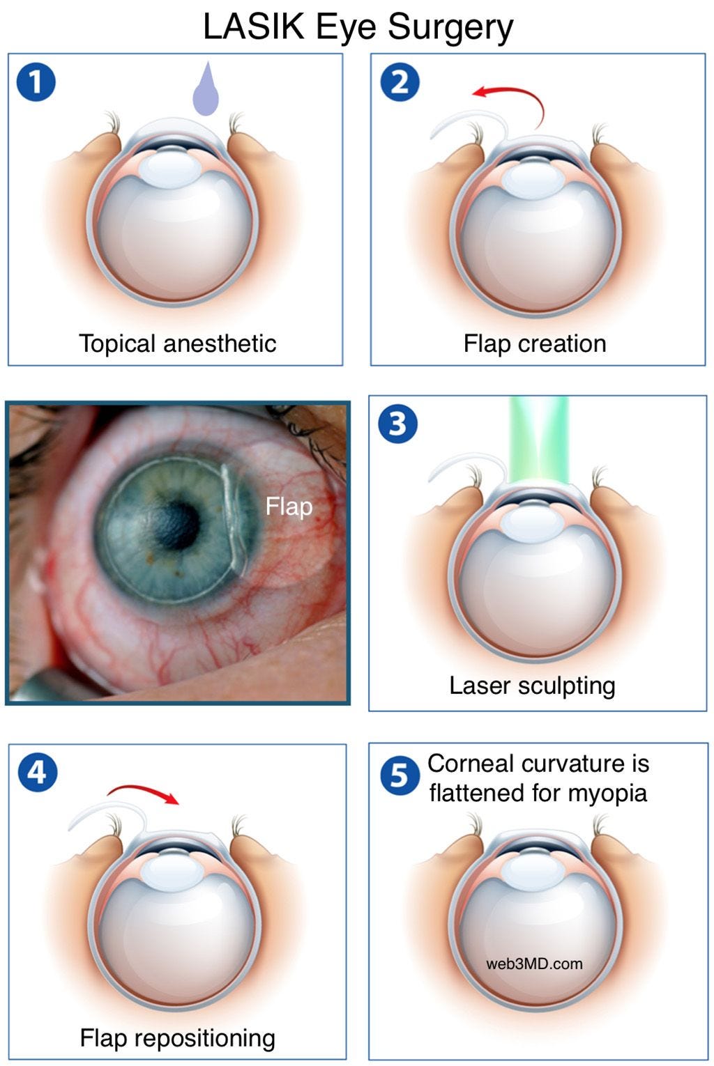 My LASIK Eye Surgery Experience. This article is not written by a… | by  Kavishka Gamage | Medium