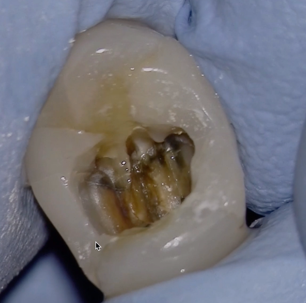 Calcified Teeth — A scrapbook of calcified pulp tissue by Ashley Mark Medium