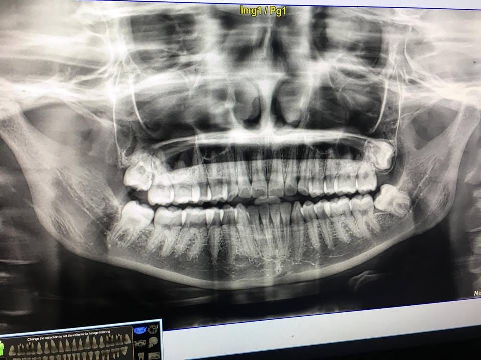 How Could I Overcome Wisdom Teeth Near Nerve Surgery By Nha Khoa Nacera Medium