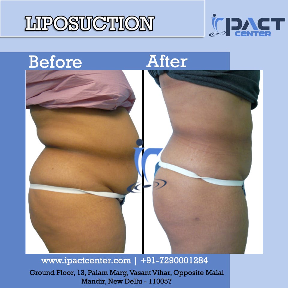 liposuction surgery in Delhi