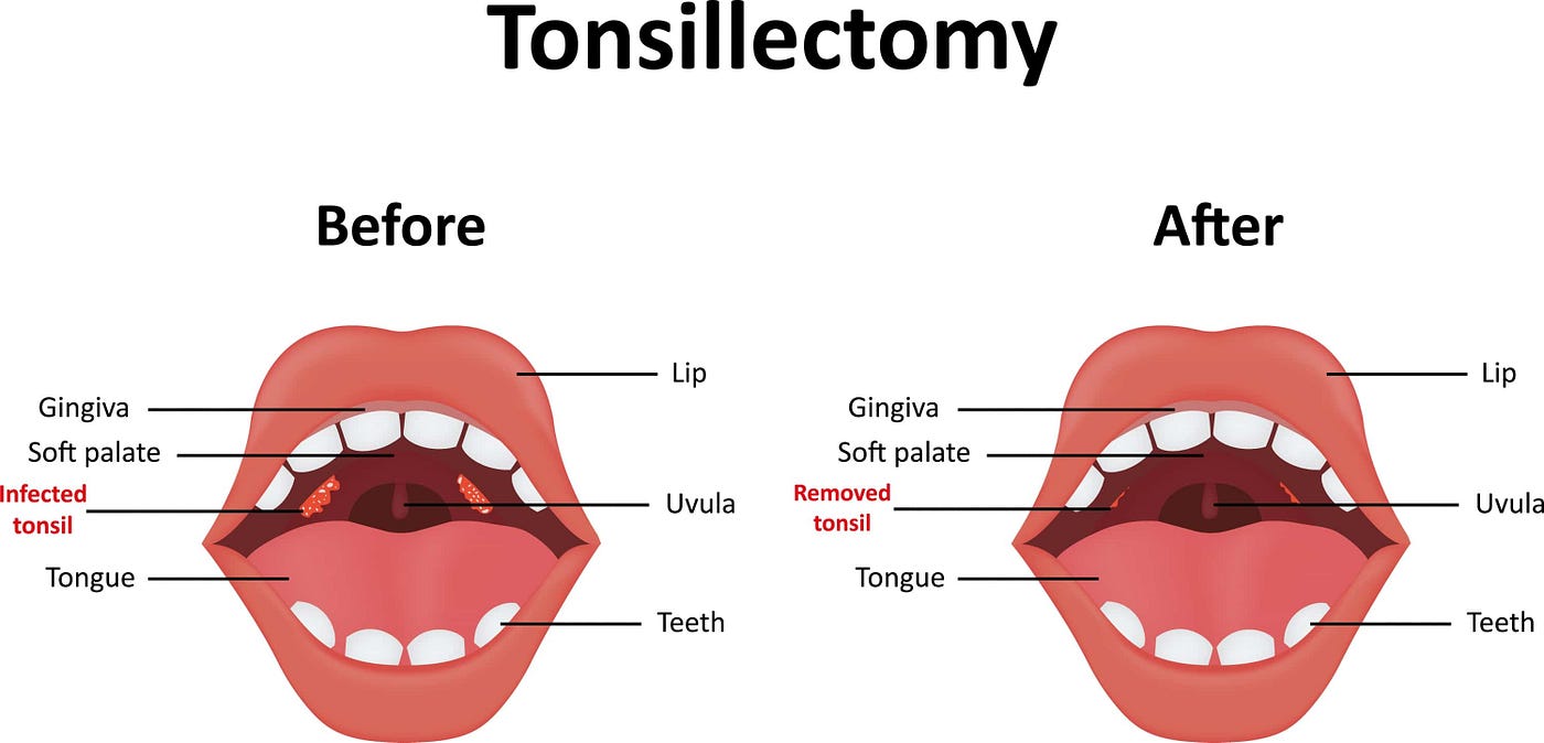Coblation Tonsillectomy to Stop Snoring by Stella maxwell Medium