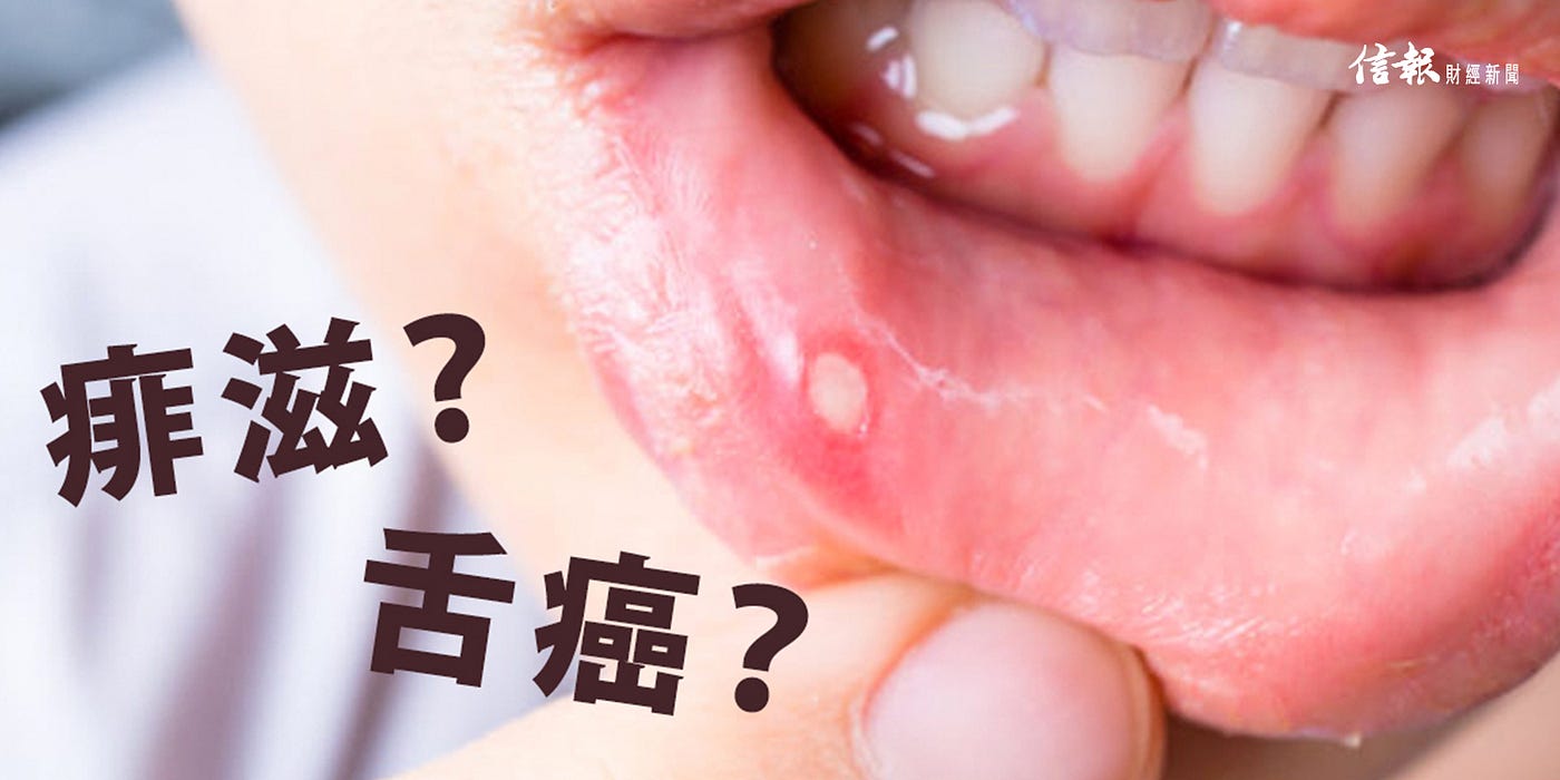 痱滋 舌癌 信報財經新聞hkej Medium