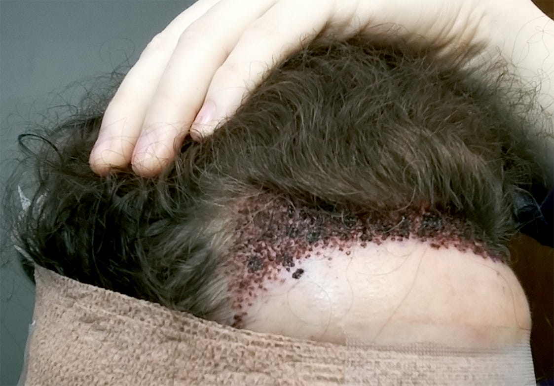 I Got A Hair Transplant — Here's What It Was Like (With Photos) *Updated* |  by Lacey Artemis | Medium