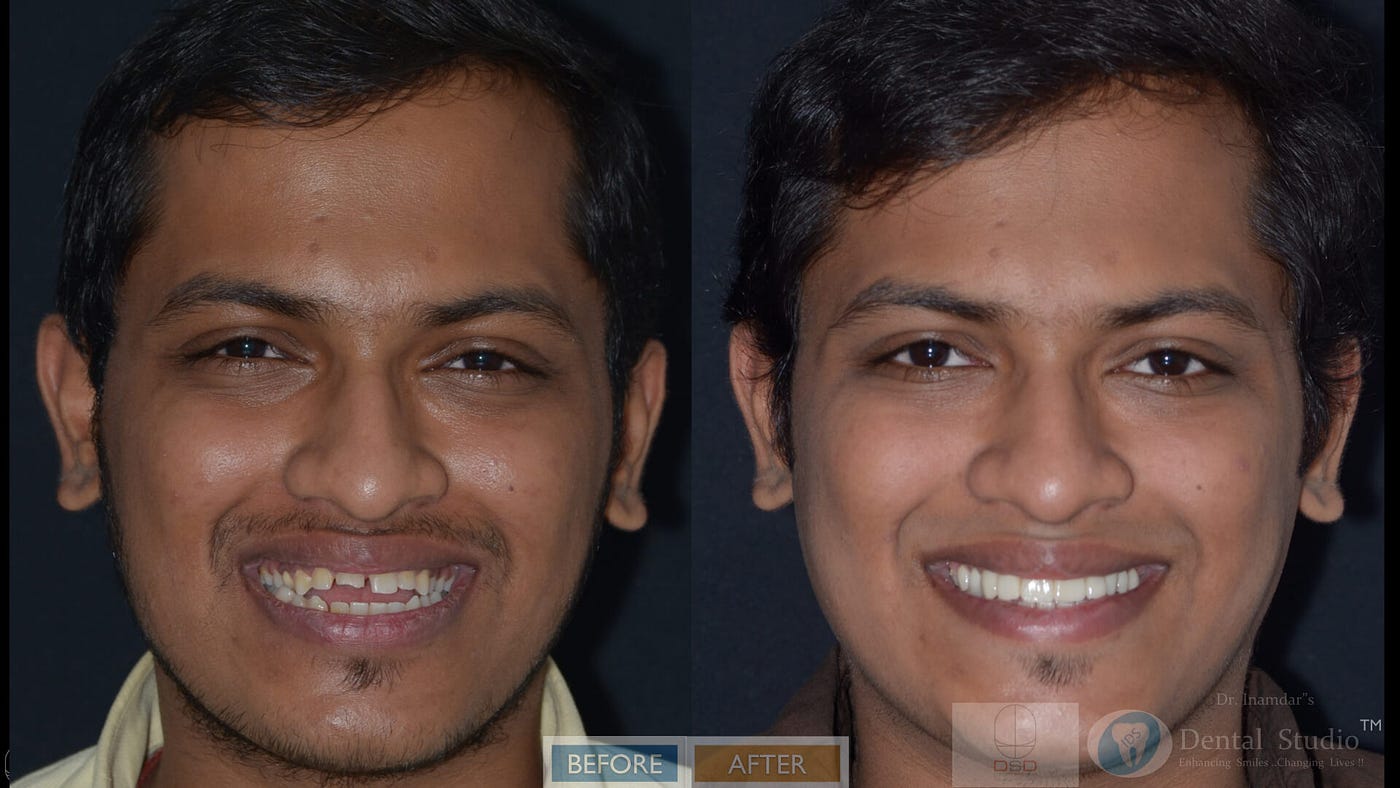 Get your designer smile — The Digital Way | by Aarav Verma | Medium